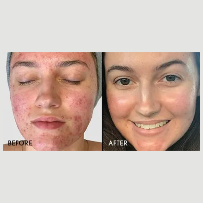 Comprehensive before and after transformation of a patient treated for severe acne, demonstrating clear skin results and localized healing in the jawline and chin area..