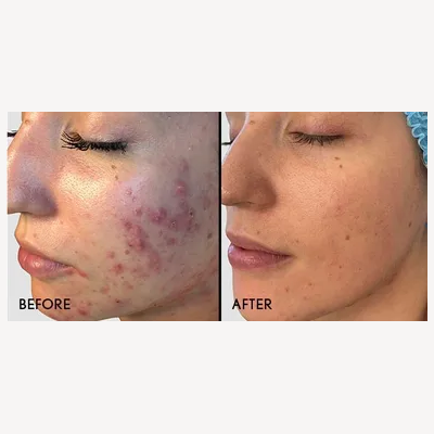 Before and after comparison of professional acne treatment at Laser Skin Solutions Portland, showing a significant reduction in active cystic acne and improved skin texture on the cheek.
