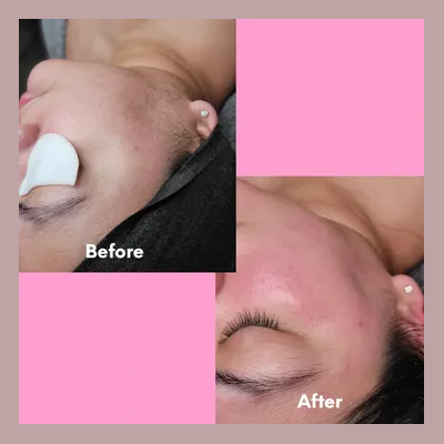Close-up of a Hydrofacial treatment at Laser Skin Solutions Portland, showing the deep cleansing and hydration process on a patient's cheek to improve skin clarity.