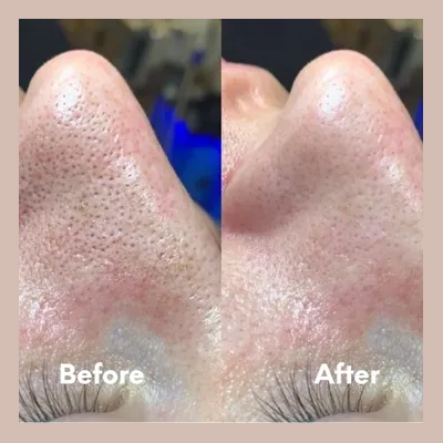 Clinical before and after results of a professional facial targeting the jawline and chin, highlighting a clearer complexion and reduced congestion.