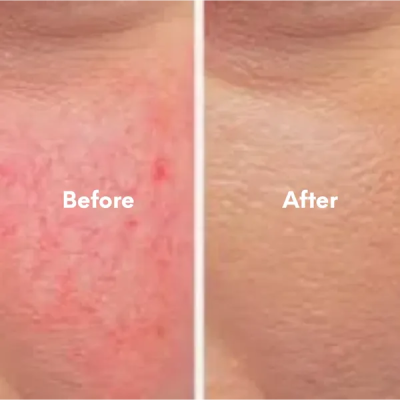 Before and after comparison of laser spider vein removal treatment on the face, showing significant reduction in vascular lesions.
