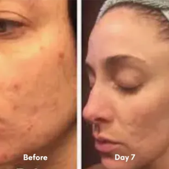 Before and after results of a professional chemical peel at Laser Skin Solutions in Portland, OR, showing significant reduction in acne scarring and sun damage.