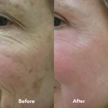 Before and after results of a professional chemical peel at Laser Skin Solutions in Portland, OR, showing reduced fine lines and improved skin texture.