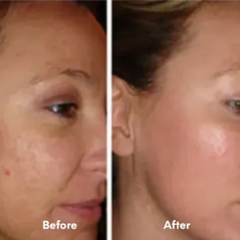 Before and after results of a permanent laser hair removal treatment on the legs at Laser Skin Solutions in Portland, OR.