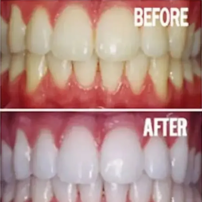 Professional LED teeth whitening before and after results at Laser Skin Solutions in Portland, OR, showing a brighter and whiter smile.