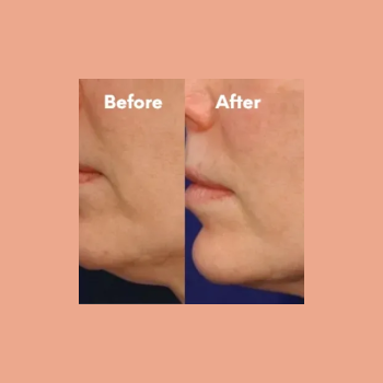 Before and after results of VelaShape jowl skin tightening at Laser Skin Solutions in Portland, OR, showing a firmer and more contoured jawline.
