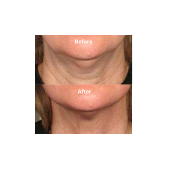 neck and chin Skin Tightening treatments Portland