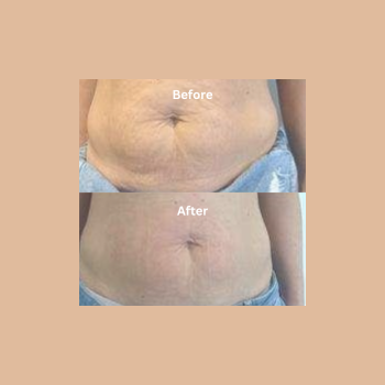 VelaShape Stomach skin tightening Portland treatments to reduce loose skin on the stomach.
