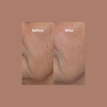 Before and after results of non-surgical jowl tightening and lower face contouring at Laser Skin Solutions in Portland, OR.