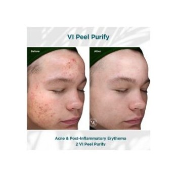 Before and after results of a VI Peel Purify treatment for acne and post-inflammatory erythema at Laser Skin Solutions in Portland.