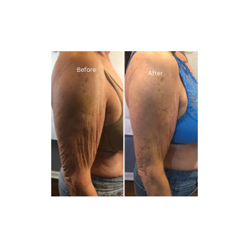 Licensed Advanced Aesthetician at Laser Skin Solutions in Portland performing a professional laser skin resurfacing treatment.