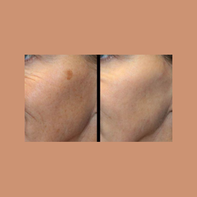 Close-up of skin pigmentation and sunspots before and after an IPL photofacial treatment to even out skin tone