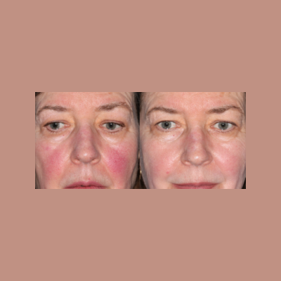 Before and after comparison of IPL treatment for rosacea showing a significant reduction in facial redness and visible blood vessels.