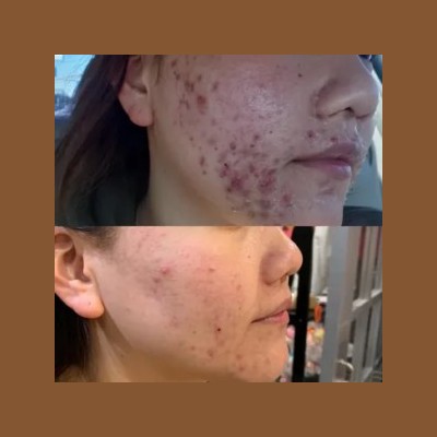 Clinical before and after results of an IPL photofacial treatment for active acne and skin clearing at Laser Skin Solutions in Portland.