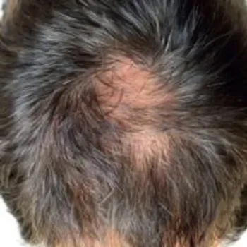 Before Before and after hair restoration results showing increased follicle density on the crown.