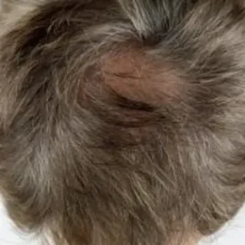 After Close-up after photo showing vertex hair regrowth results following exosome therapy at Laser Skin Solutions in Portland.