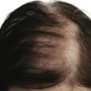 After Visible scalp reduction and improved hair volume in a patient following regenerative hair restoration sessions at Laser Skin Solutions in Portland.