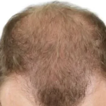 Before and after hair restoration results showing improved density and hairline thickness at Laser Skin Solutions in Portland.